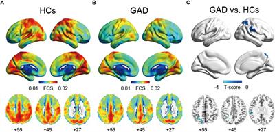 Decreased Intrinsic Functional Connectivity in First-Episode, Drug-Naive Adolescents With Generalized Anxiety Disorder